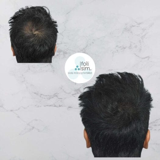 what is scalp micropigmentation?