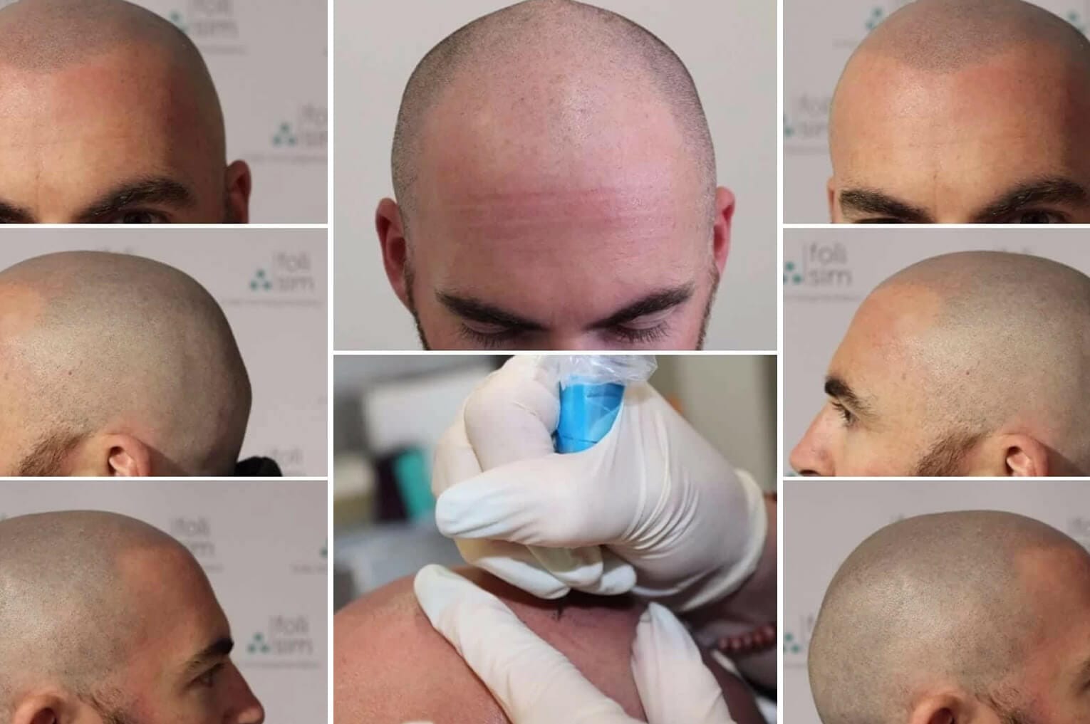 How Scalp Micropigmentation Changed my Life