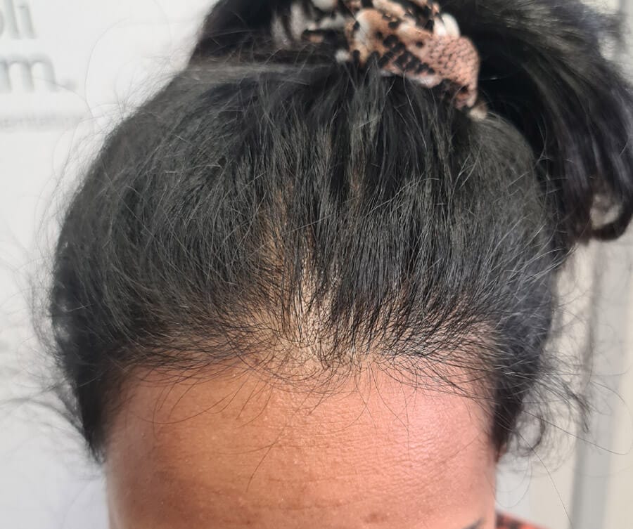 before scalp micropigmentation for women