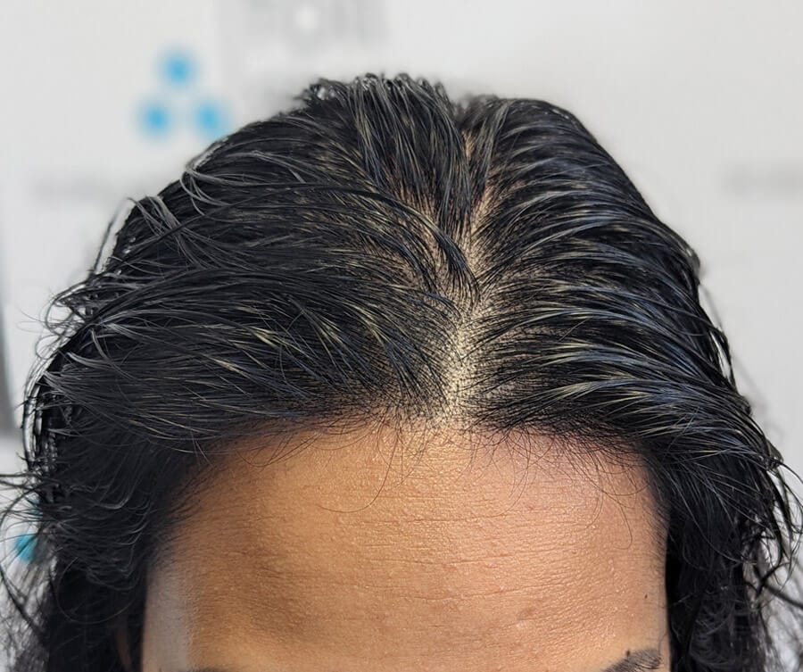 after scalp micropigmentation for women