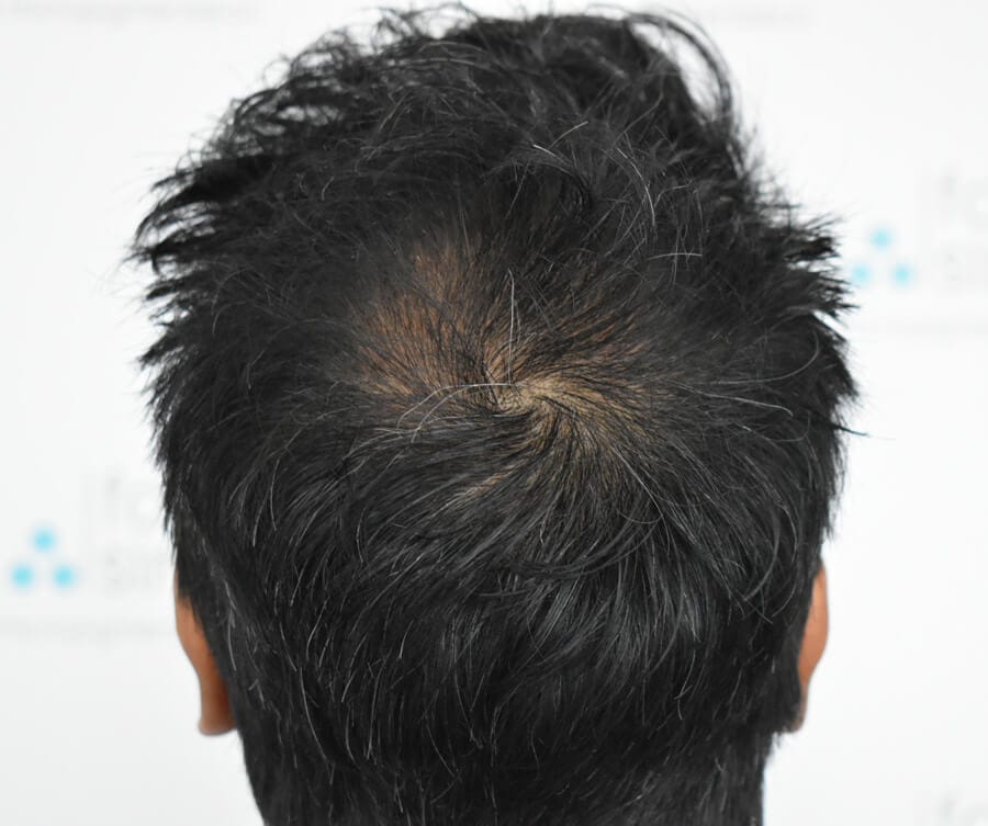 smp treatment before smp treatment before
