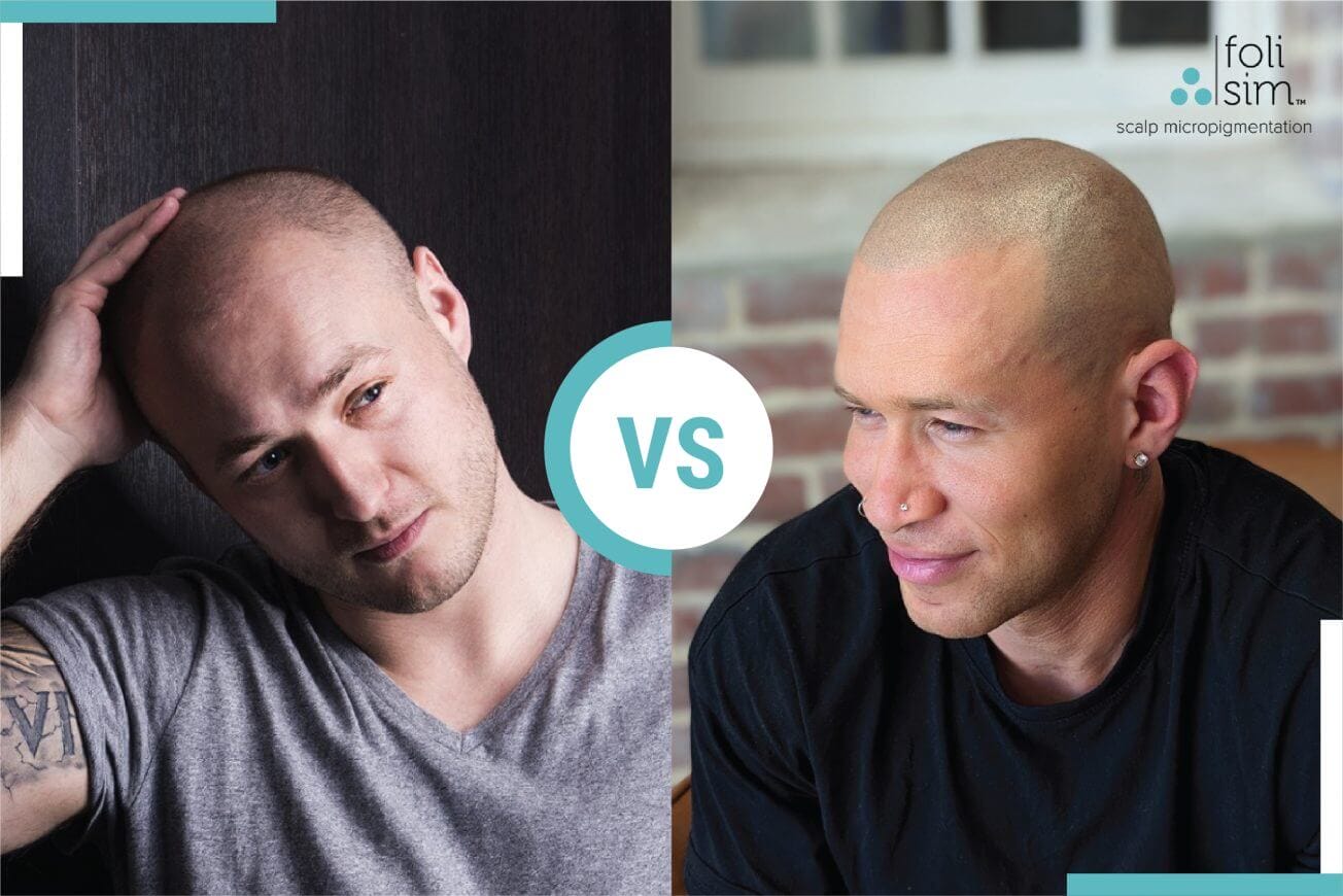 Navigating Scalp Micropigmentation Regrets: Expert Advice