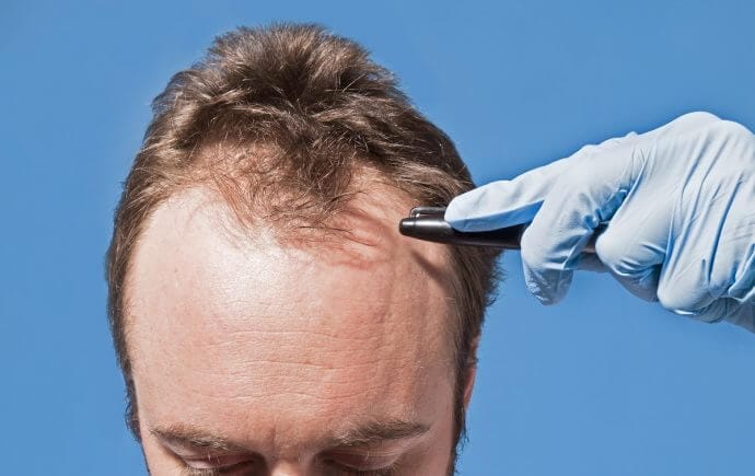 scalp micropigmentation regrets
