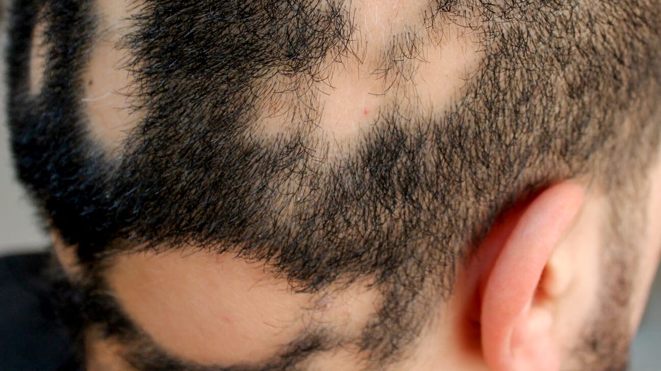 Hair loss on a man