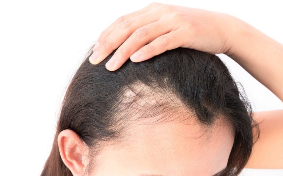 Sign of hair loss another condition