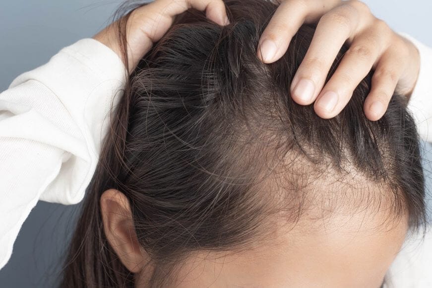 Common Misconceptions About Alopecia