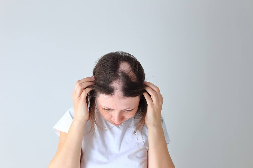 what causes alopecia