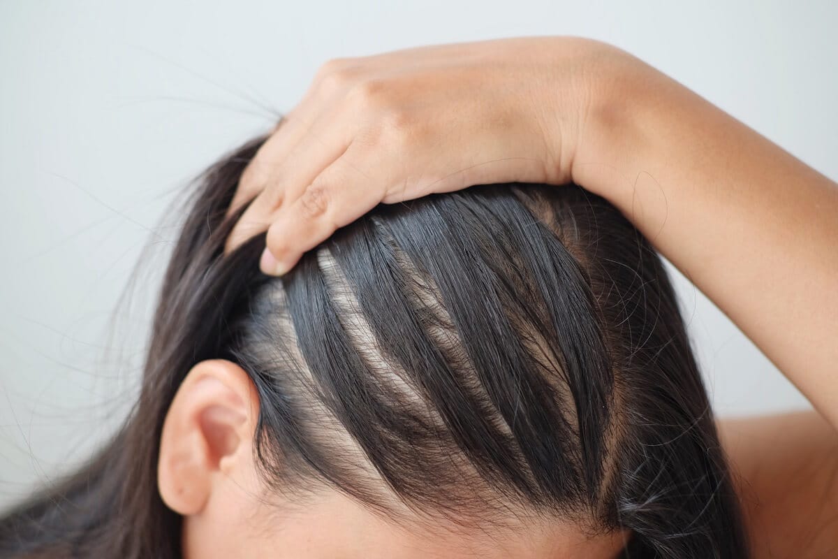 Understanding the Causes of Hair Loss in Women