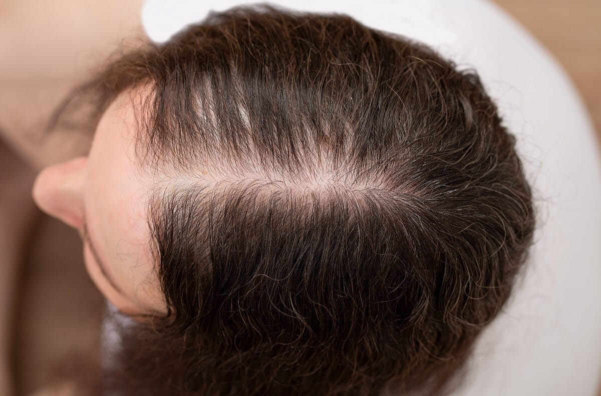 SMP for thinning and patchiness in women