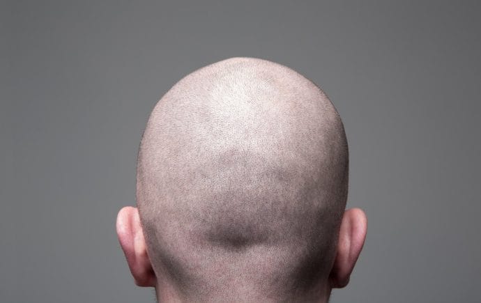 shave your head for scalp micropigmentation