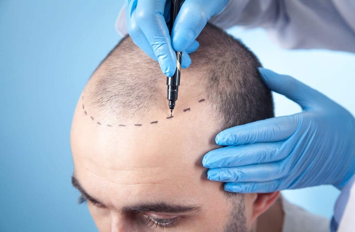 Latest Hair Loss Treatments - smp